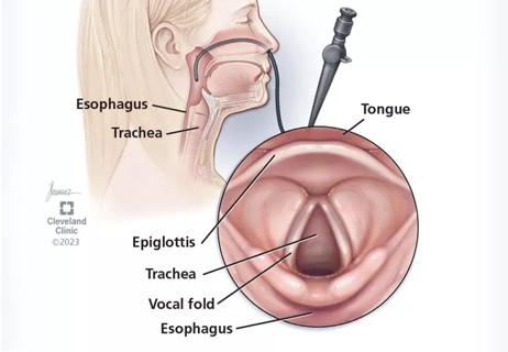 Hoarseness