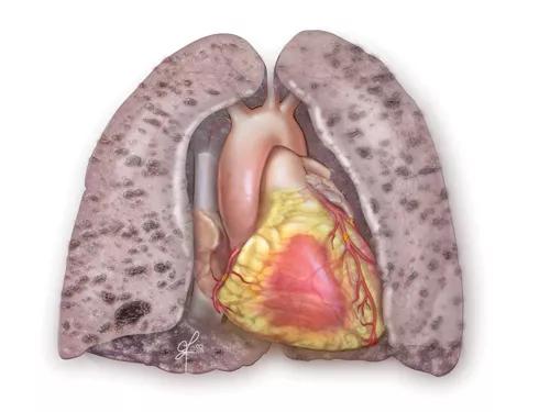 Figure 1. Illustration of fibrotic lungs with concomitant coronary artery disease.