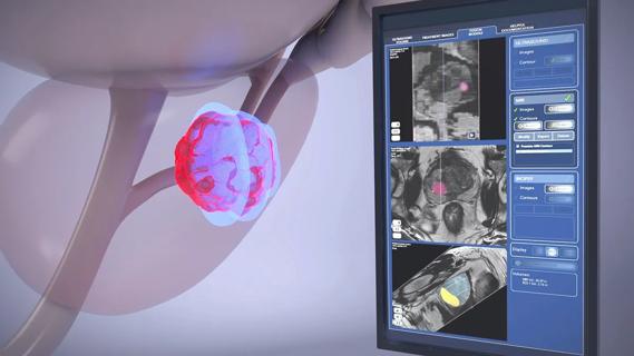 Image of HIFU Procedure