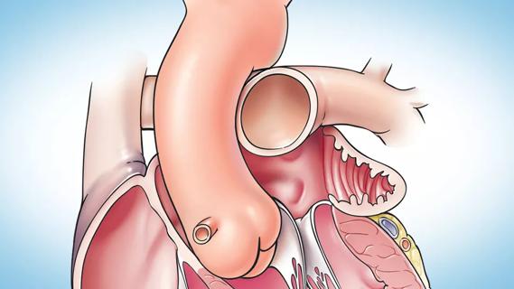 illustration of the human heart focused on the left atrial appendage