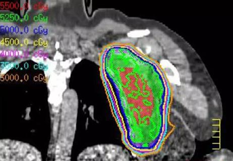 Sarcoma-treatment_650x450