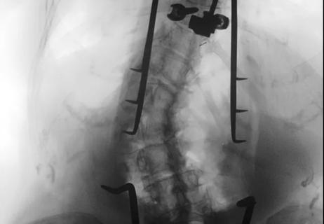 18-NEU-4009-spinal-fusion-scoliosis-650&#215;450