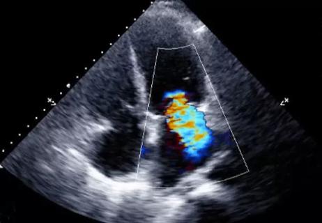 Imaging Mitral Regurgitation in Pursuit of Progression Predictors