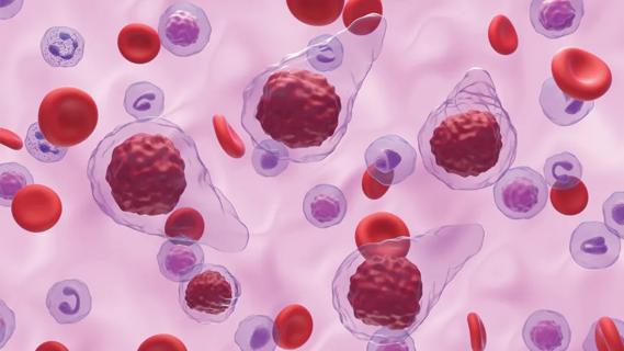 Myelofibrosis cells