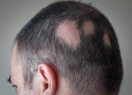 Person with alopecia areata