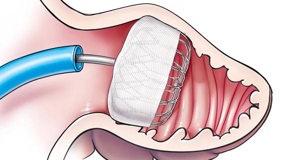 medical device deployed in the heart's left atrial appendage