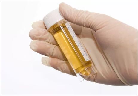 urine-sample_650x450