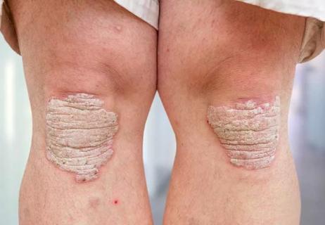 Grey psoriasis on knees