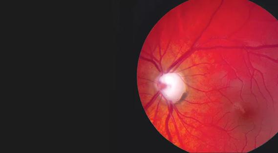690&#215;380-eye-Challenges in treating childhood glaucoma