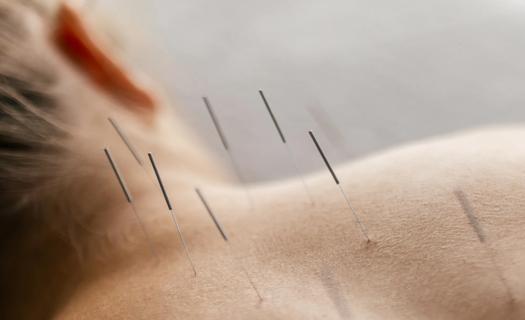 Acupuncture