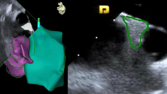 side-by-side heart scans with color markings