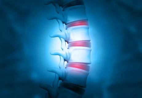 illustration of spine with flare up of pain and disks