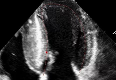 echocardiogram showing strain imaging assessment