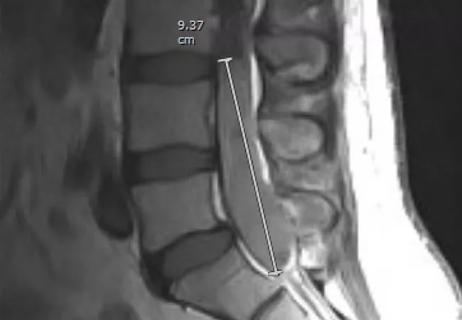 MRI showing a spinal ependymoma