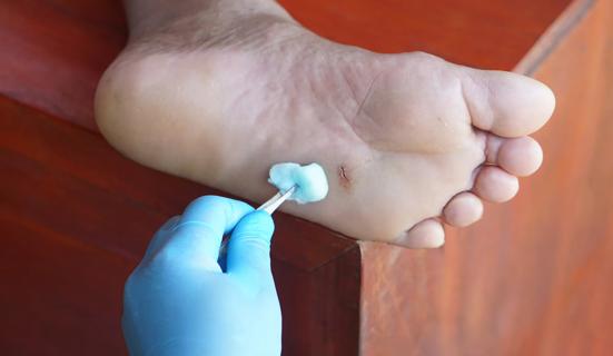 The bottom of a foot with a cut in it being dabbed with cotton by gloved hand