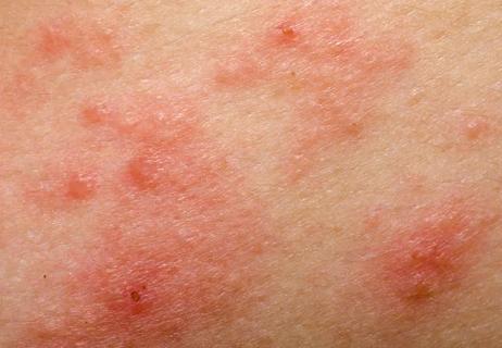 phototxicity skin rash