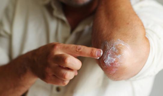 Person apply skin cream to their red and irritated elbow