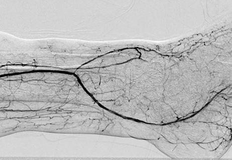 Critical Limb Ischemia: A Look-Back at a Year of Abundant Insights (Video)