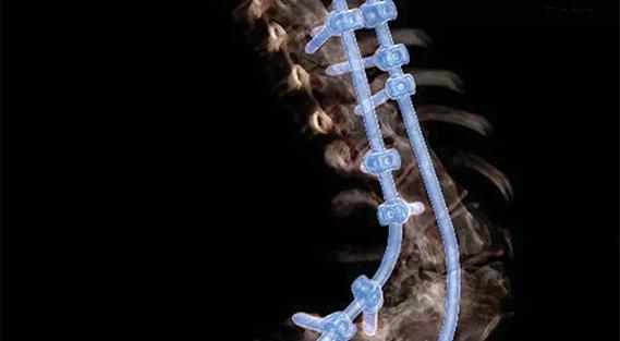 spinal-cqd-690&#215;380