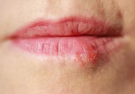 zoom in on lips with cold sore