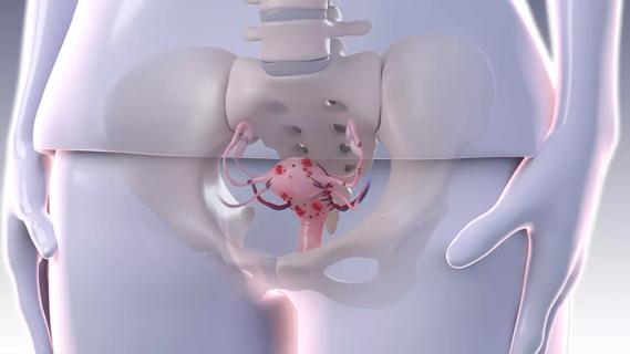 Medical illustration of endometriosis