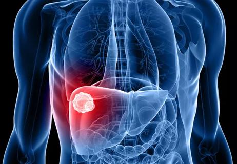 16-DDI-1471-HilalCholangiocarcinoma-CQD-650&#215;450