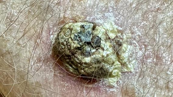 Squamous cell carcinoma