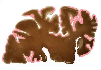 20-NEU-1873707-multiple-sclerosis-brain-sample-650&#215;450
