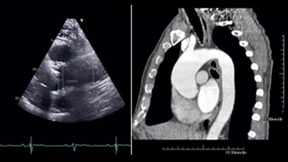 cardiac echo and cardiac CT images side by side