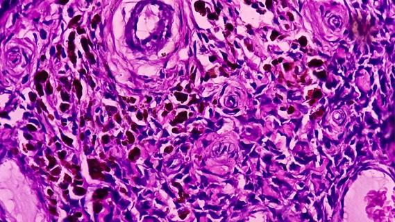 Synovial sarcoma cells