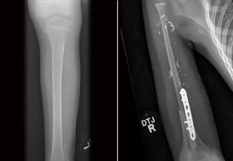 OrthoHemi, OrthoHemi Shoulder