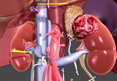 650&#215;450-Thrombectomy