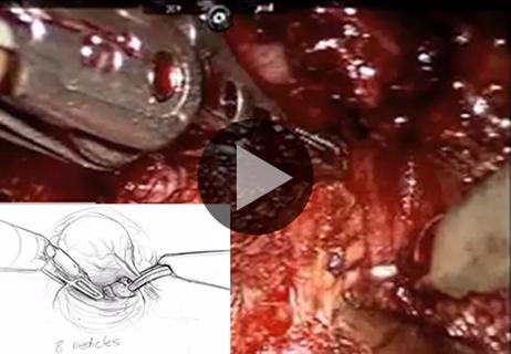 650&#215;450 perineal prostatectomy