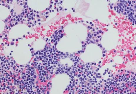 multiple myeloma