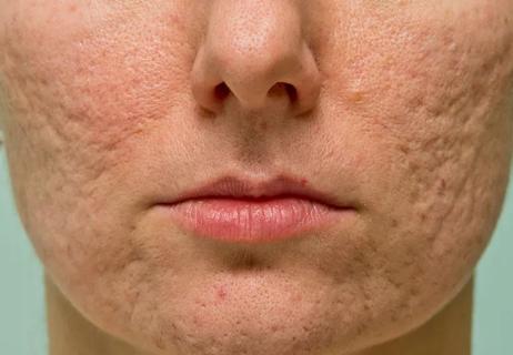 face of woman with acne scarring