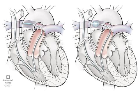 Pulmonary artery catheterization illustration