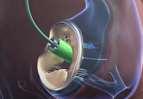 percutaneous-mitral-valve-procedure_650x450