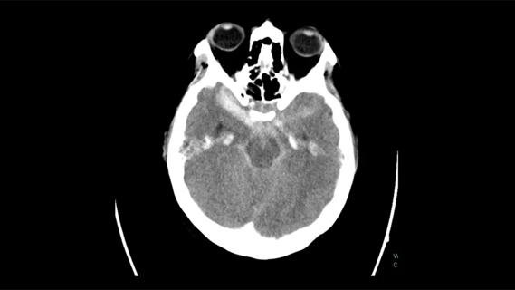 head CT scan showing subarachnoid hemorrhage