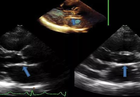 echocardiograms showing heart valve disease