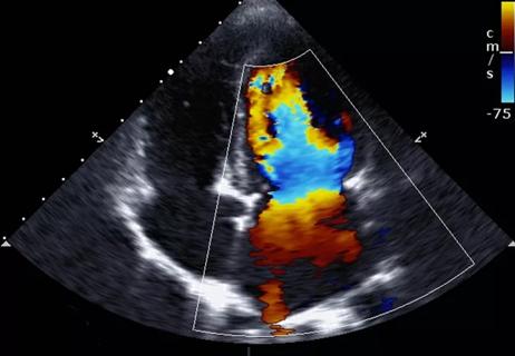 17-DDI-4596-Bariatric-Heart