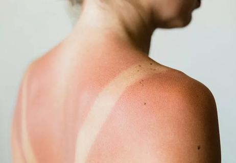 girl with severe sunburned tan lines on shoulders