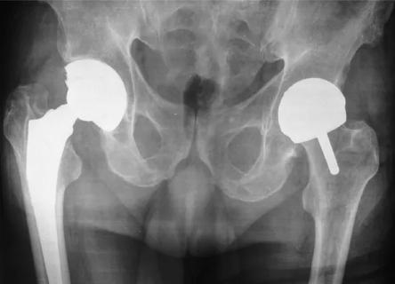 One total hip replacement; one hip resurfaced