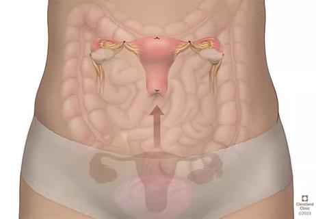 uterine transposition