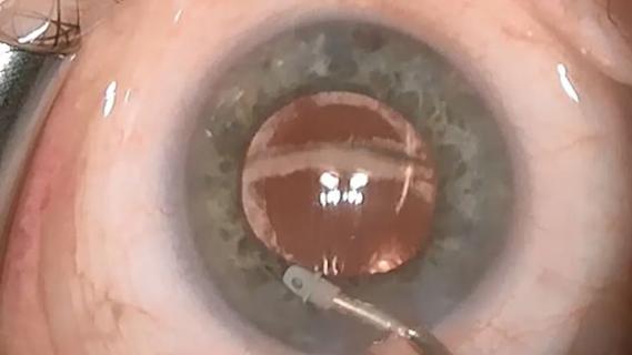 Eye with a strip of trabecular meshwork remaining after glaucoma surgery