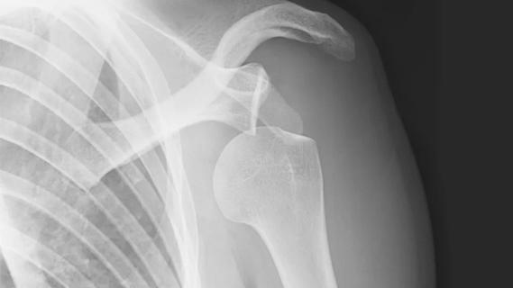 Shoulder dislocation x-ray
