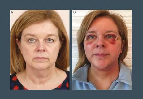 Bilateral rhytidectomy with extended SMAS and fat injections to the cheeks, peroperative and postoperative photos