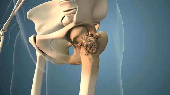 Bone metastasis