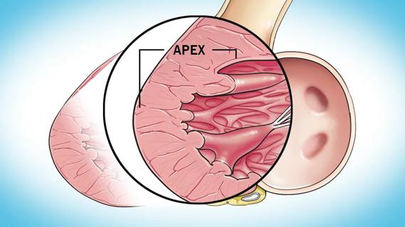 left ventricular apex in heart affected by hypertophic cardiomopathy