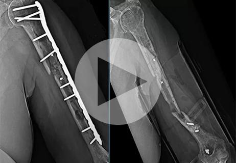 OrthoHemi, OrthoHemi Shoulder