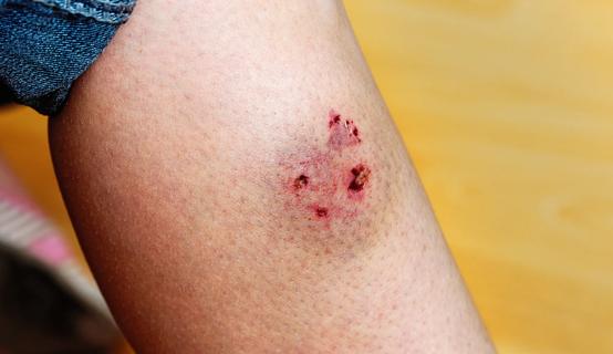 Leg with fresh animal bite wound